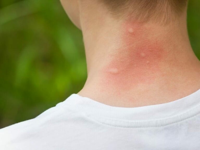 Are There Mosquitoes in Hawaii? Find out how to Avoid Them